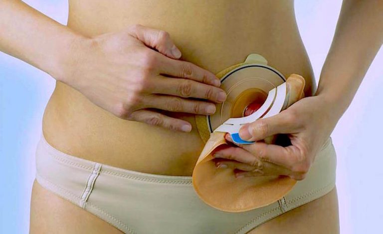 paziente-con-stomie-dottoressa-edy-virgili